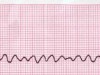 Lead_II_rhythm_generated_ventricular_fibrilation_VF